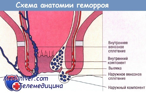 Когда возможно лечение геморроя в домашних условиях без проктолога?